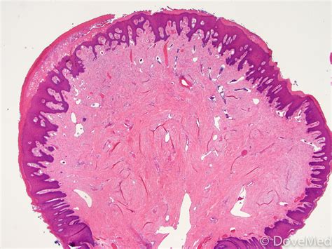 Irritation Fibroma