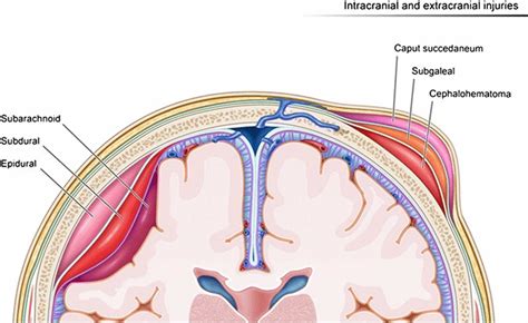 Caput succedaneum causes, resolution & caput succedaneum treatment