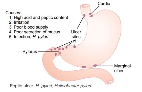 Peptic Ulcer - Disorders of the Stomach