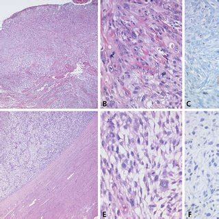 Histology of atypical fibroxanthoma (AFX: A, B, C) and undifferentiated... | Download Scientific ...