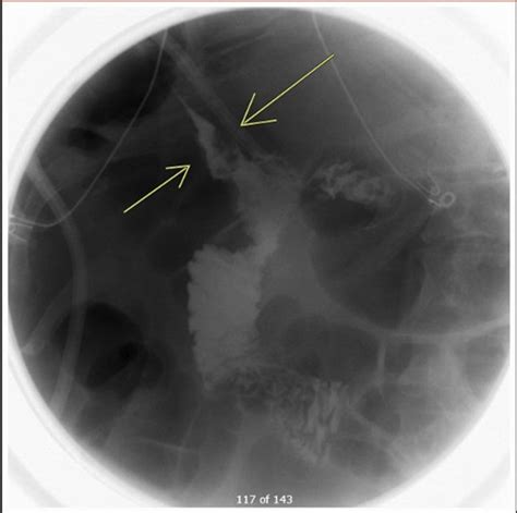 Upper GI series demonstrating a persistent leak in the duodenum... | Download Scientific Diagram