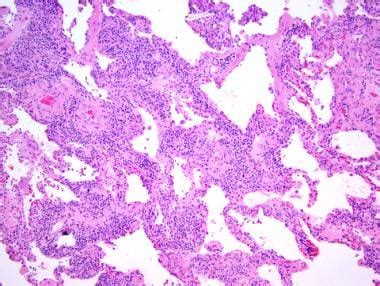 Interstitial Pneumonia Histology