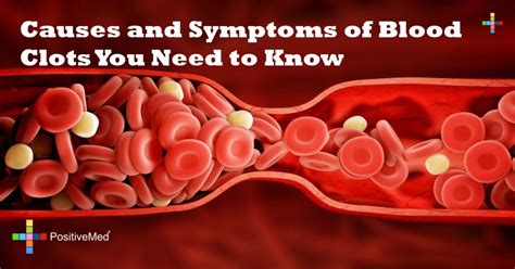 Causes and Symptoms of Blood Clots You Need to Know - PositiveMed