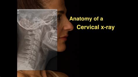 Anatomy of a Cervical x-ray - YouTube