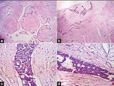 18 best "Phyllodes tumor" images on Pinterest | Arrow, Arrows and Foundation