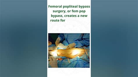 What Is Femoral Popliteal Bypass Surgery? - YouTube