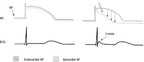 Schematic representation of the possible mechanisms underlying J-wave... | Download Scientific ...