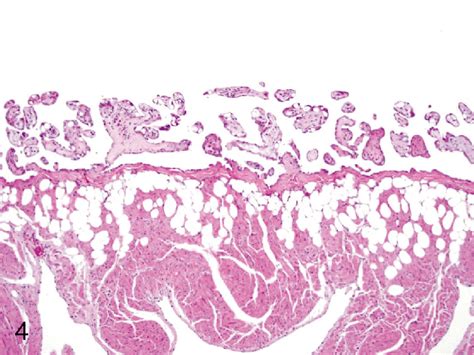 Heart: Proliferation of the epicardial mesothelium. Focal papillary... | Download Scientific Diagram