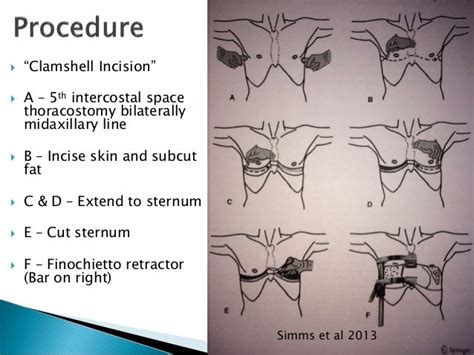 Emergency Thoracotomy