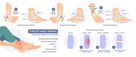 Deltoid Ligament Sprain | How to Treat a Sprain of the Deltoid Ligament