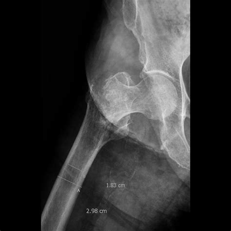 Intertrochanteric Fractures – Core EM