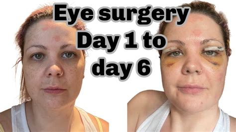 My Blepharoplasty experience eyelid surgery and recovery day 1 to 6 - YouTube