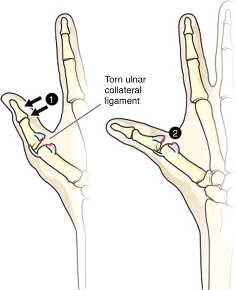 Ulnar Collateral Ligament Tear of the Thumb (Ski Pole or Gamekeeper’s ...