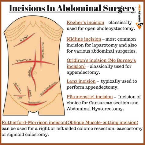 Open Appendectomy Incision