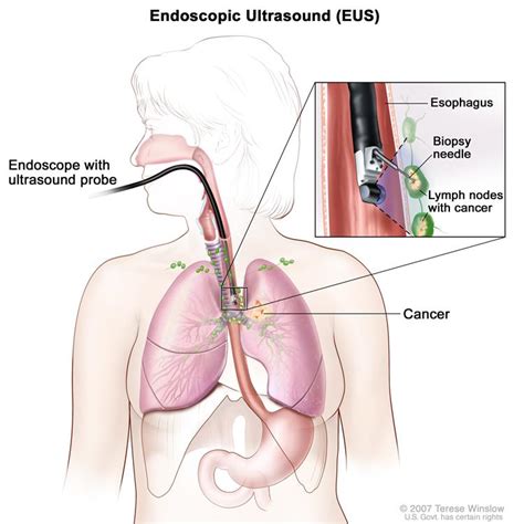 Endoscopic ultrasound-guided fine-needle aspiration biopsy; drawing shows an endoscope with an ...