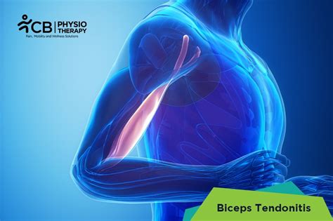 What is Biceps Tendonitis? Symptoms, Causes, Diagnosis & Physiotherapy ...