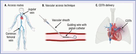 Catheter-directed therapy to treat intermediateand high-risk pulmonary ...