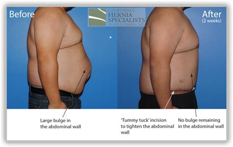 Hernia Types - Recurrent - California Hernia Specialists