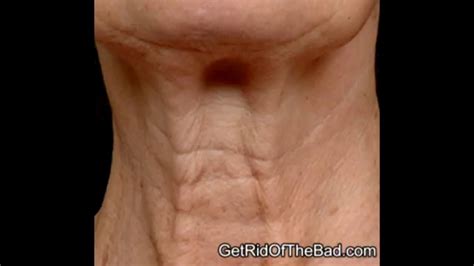 HOW TO - Get rid of Turkey Neck (Turkey Neck exercises) - YouTube