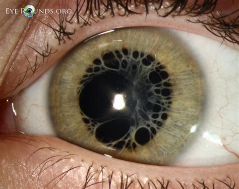 Persistent pupillary membrane : The University of Iowa, Ophthalmology