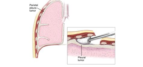 Pleurectomy and Decortication