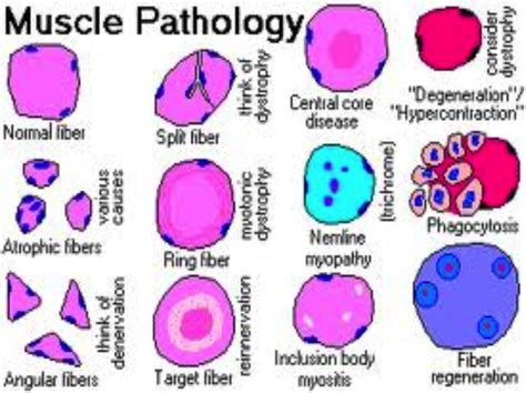 What Are the Most Common Types of Myopathy Quizlet