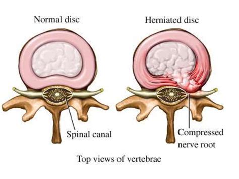 Herniated Nucleus Pulposus