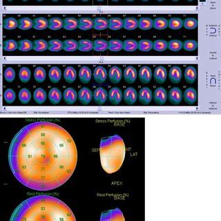 Myocardial perfusion SPECT (Single Photon Emission Computed Tomography ...