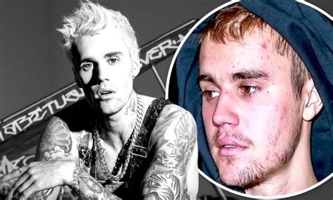 Justin Bieber Reveals He Is Suffering From "Incurable" Lyme Disease ...