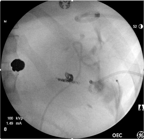 Initial Left Retrograde Pyelogram Left retrograde pyelogram showing ...