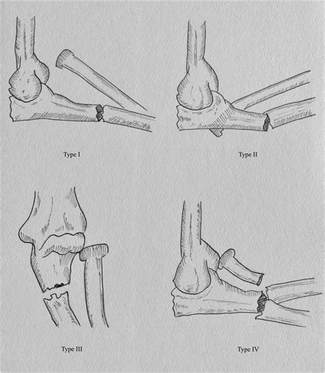 Bado classification for Monteggia fracture dislocation. | Download Scientific Diagram