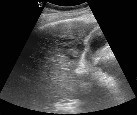 Porta Hepatis Lymph Node