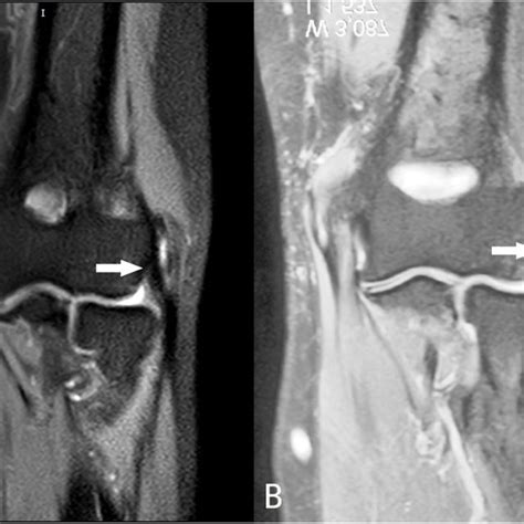 Examples of MRI findings on the LCL. A 53-year-old female, MRI showed... | Download Scientific ...