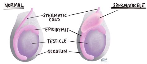 Spermatocele - MyPathologyReport.ca