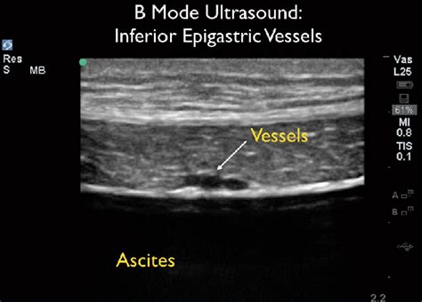 Inferior epigastric vessels (B-mode). | Download Scientific Diagram