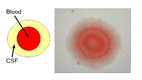 Total 50+ imagen halo test csf - Viaterra.mx