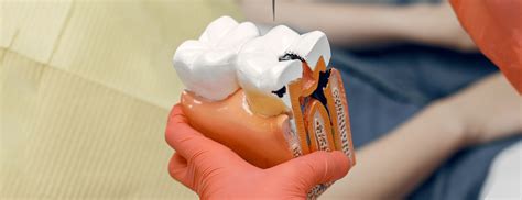 Tooth Root Resorption – Symptoms, Causes, Treatment