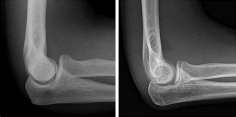 Find 2 signs of a fracture in this elbow. I know it is potato quality ...