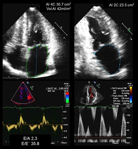 Ecocardiograma De Insuficiencia Cardiaca