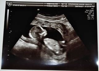 Ultrasound 6c | Profile at 14 weeks. | myllissa | Flickr