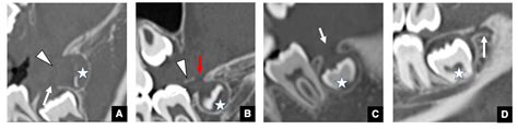 JCM | Free Full-Text | Overview of Radiological Studies on Visualization of Gubernaculum Tracts ...