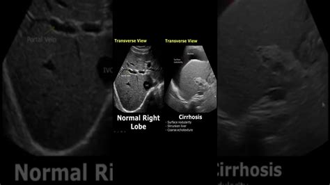 Liver Cirrhosis On Ultrasound | Ascites | Chronic Liver Disease USG Normal Vs Abnormal #shorts ...