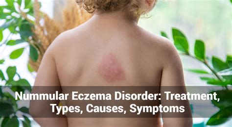 Nummular Eczema Disorder: Treatment, Types, Causes, Symptoms | Eczemaless