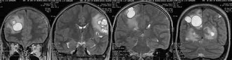 Dr Balaji Anvekar FRCR: Multiple ring enhancing lesions in brain