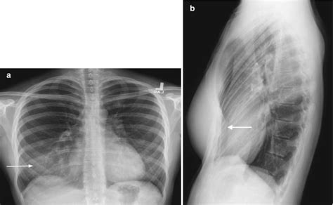 Fig. 1.1, [(a, b) Pectus excavatum chest...]. - Diseases of the Chest, Breast, Heart and Vessels ...