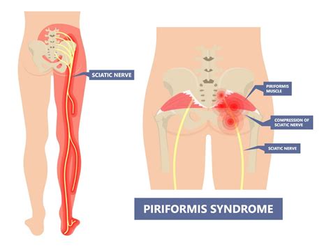 Piriformis Injection Landmarks