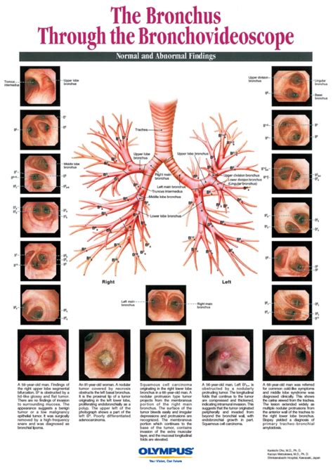 The Bronchus Through the Bronchovideoscope Poster - Olympus Professional Education On-Demand Library