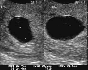 Alexa Image: Blighted ovum at 12 weeks