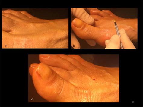 Percutaneous tenotomy of the extensor digitorum longus. a Visible ...