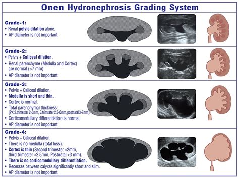 Frontiers | Grading of Hydronephrosis: An Ongoing Challenge